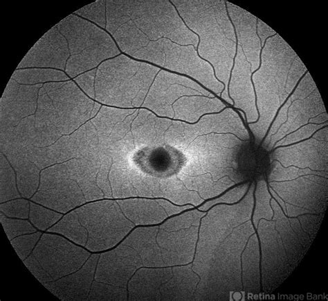 "The Eye of Sauron" - Retina Image Bank