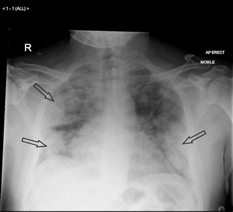 42+ Was It Pneumonia Or Covid PNG