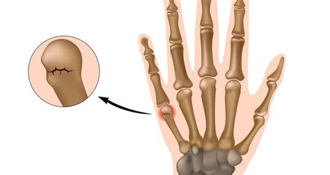 Boxer's Fracture - Symptoms, Causes, Treatment & Surgery