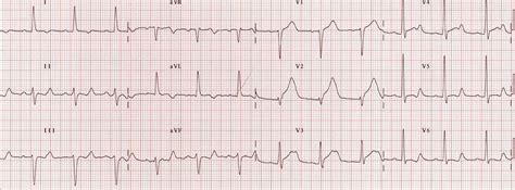 Anteroseptal MI prolonged QT | Emergency medicine, Education blog, Ekg