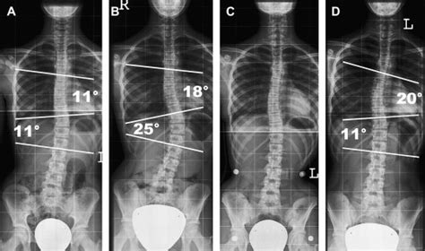 Scoliosis | Radiology Key