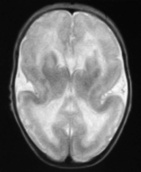 Lissencephaly Mri