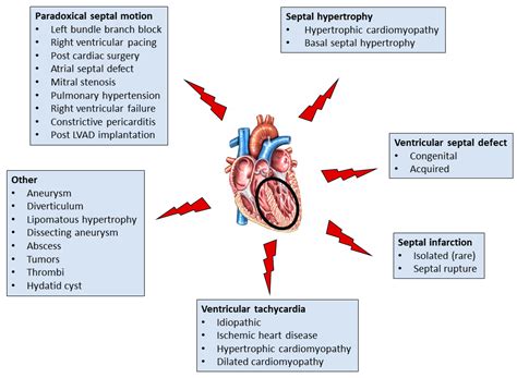 JCM | Free Full-Text | The Interventricular Septum: Structure, Function, Dysfunction, and Diseases