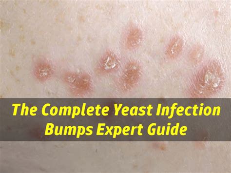 Yeast Infection Bumps - Are Your Skin Bumps Caused By Yeast Infection?