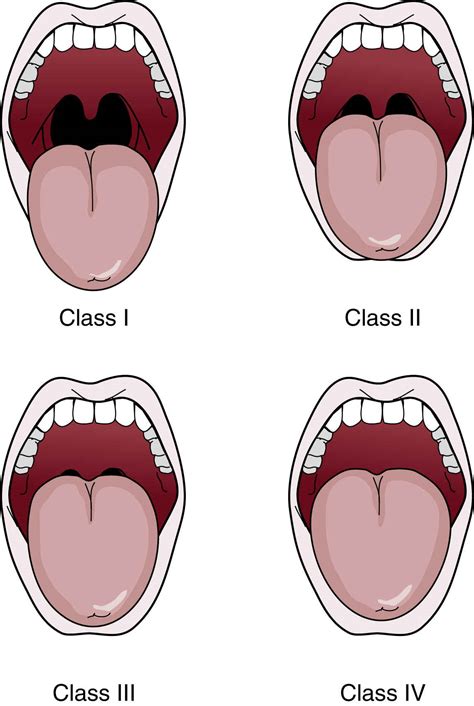 Assessment and Management of the Airway | Anesthesia Key