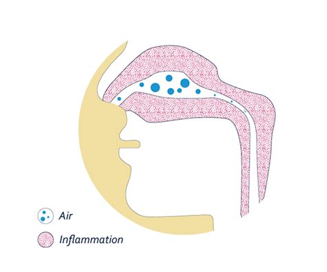 Rhume / Rhinite / Rhinopharyngite : symptômes chez l'adulte ou l'enfant - Actisoufre