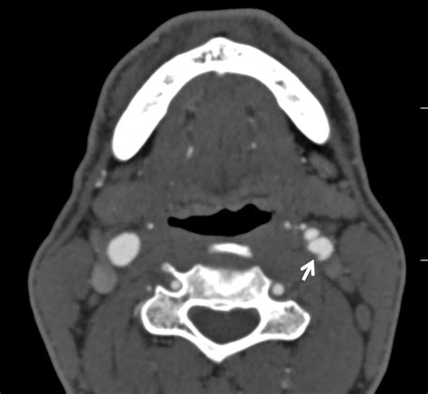 Carotid Web | neuroangio.org