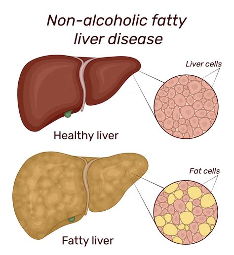 Learn About Liver Conditions and Diseases | Tulane School of Medicine