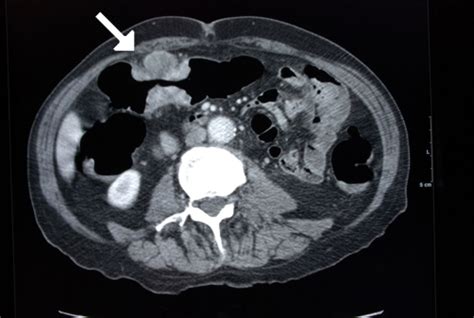 Abdominal Ct showing an apple-core lesion of the transv | Open-i