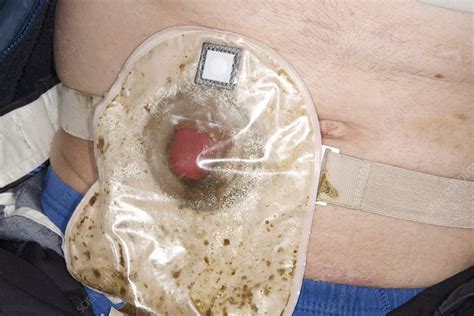 Ileostomy in rectal cancer - Stock Image - C023/4348 - Science Photo Library