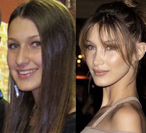 Gigi De Lana Before Surgery