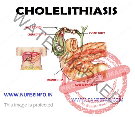 CHOLELITHIASIS AND CHOLECYSTITIS - Nurse Info