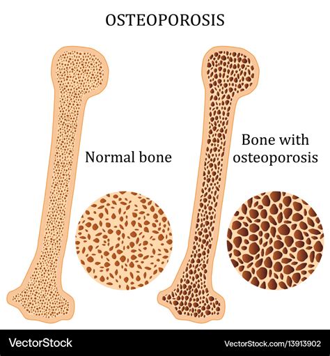 Healthy bone and osteoporosis bone Royalty Free Vector Image