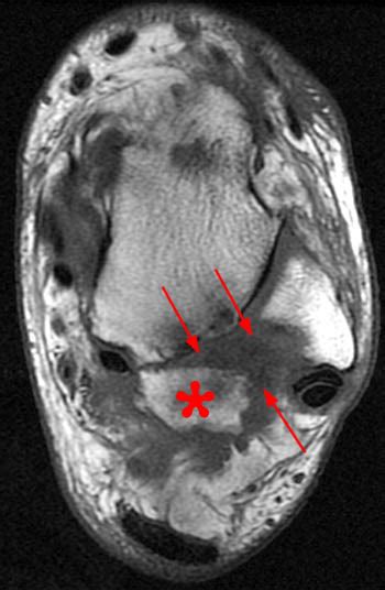 Posterior Ankle Impingement - Radsource