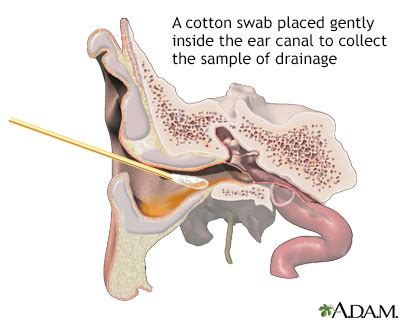 Ear drainage culture Information | Mount Sinai - New York