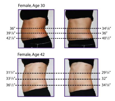 Meridian Lipo Laser Non-Surgical Body Contouring | Healthy Habits ...