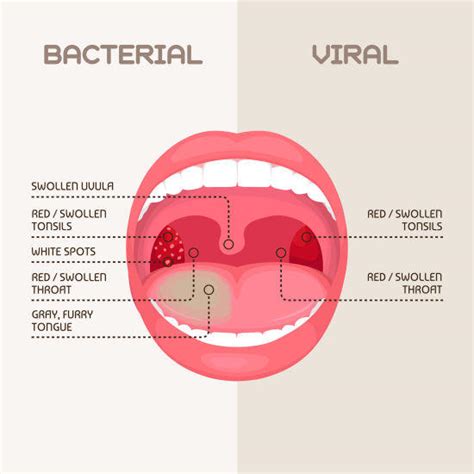 Enlarged Tonsils Strep Throat