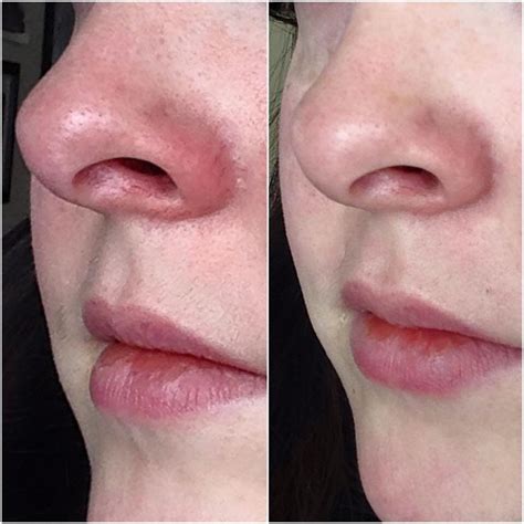 Everyone wants smaller pores!!! Check out this before and after using Nerium AD!!! Order risk ...