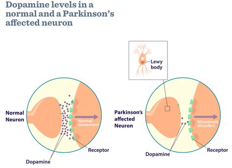 What is Parkinson's Disease - Causes, Signs, Symptoms and Treatments