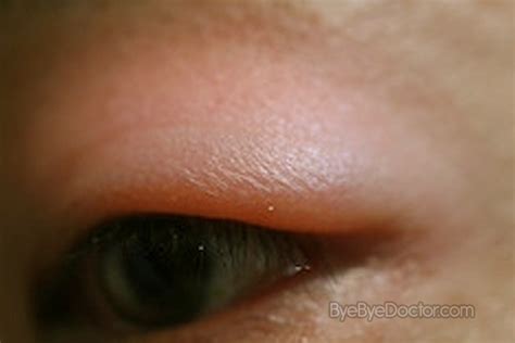 itchy eyelids allergies - pictures, photos