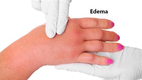 What is Edema? Symptoms, Causes, and Risk Factors – The Inside Experience