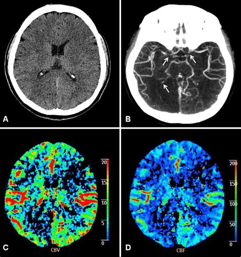 [PDF] Acute Cerebral Artery Occlusion by Direct Tumor Embolus ...