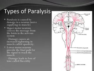 Paralysis | PPT