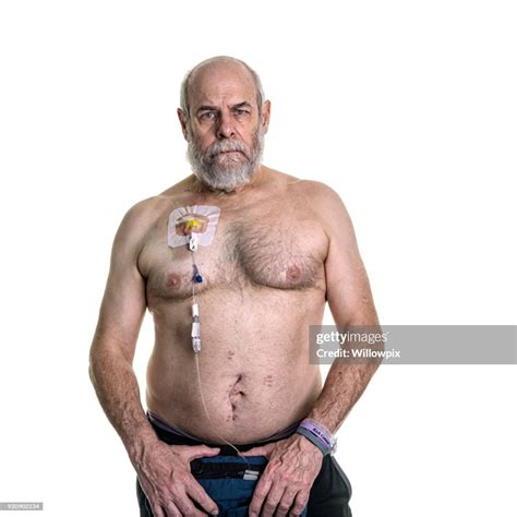 Senior Man Cancer Patient Chemotherapy Iv Pump Attached To Chest Infusion Port High-Res Stock ...