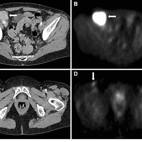 (PDF) Imaging of Pelvic Lymph Nodes