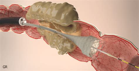 Stent placement by Through the scope technique. | Download Scientific Diagram