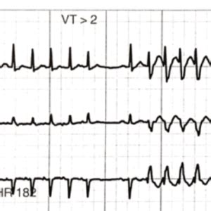 Ashman phenomenon – ECG Weekly