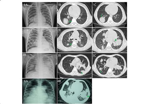 Chest film and CT scan shows a circular consolidation (3.7 × 3.1 cm ...