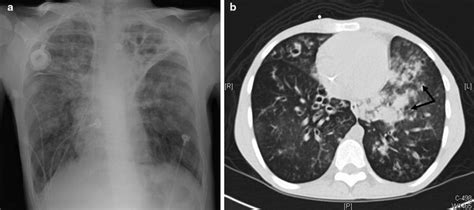 Management of Massive Hemoptysis | Radiology Key