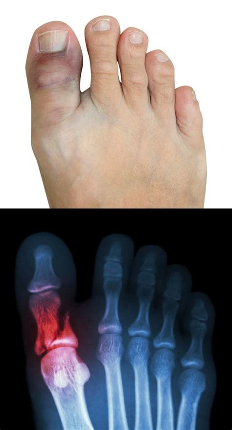 Sprained Big Toe vs. Broken Big Toe: Signs, Symptoms & Treatment Options