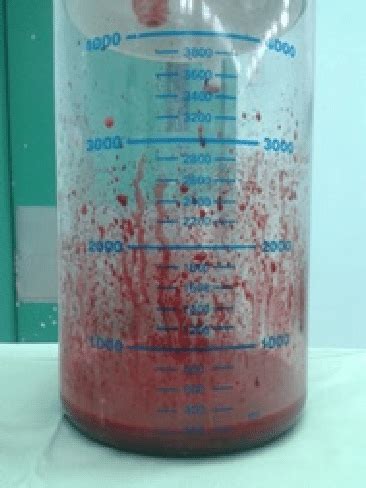 Shows 230 mL of sanguineous fluid drained during surgery mixed with 120... | Download Scientific ...