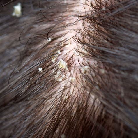 Dandruff in the Hair. Flaky Scalp Stock Photo - Image of person, dirty: 61358646