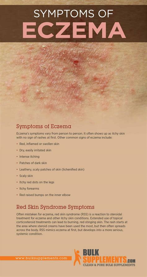 Eczema: Characteristics, Causes & Treatment