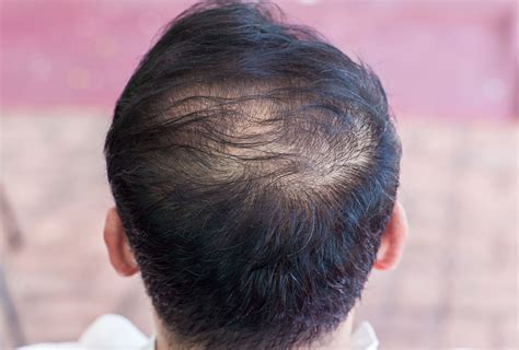 Hair Thinning: Causes, Types, & Treatment - eMediHealth