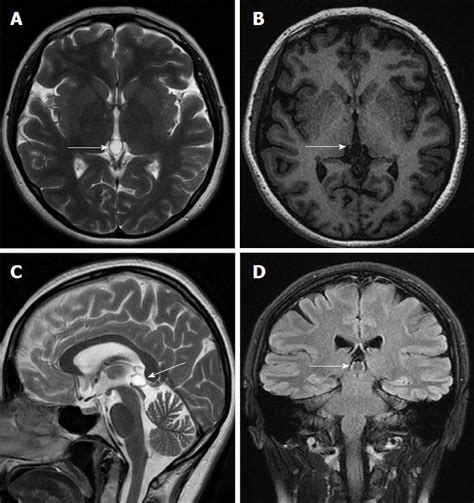 25++ Pineal Gland Cyst Mri | Muldede