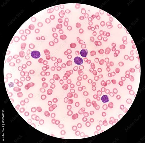 Human blood smear under 100X light microscope with blast cells and ...