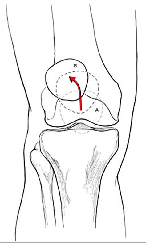 Patellofemoral Pain Syndrome - Causes, Symptoms, Treatment