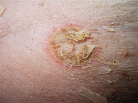 Image Gallery: Secondary Skin Lesions | Clinician's Brief