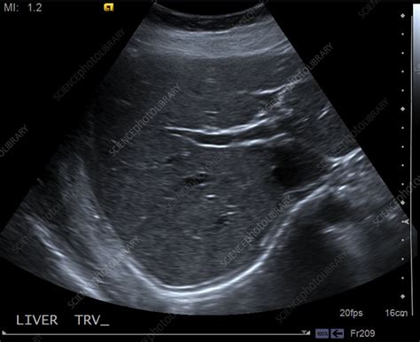 Normal liver, ultrasound - Stock Image - C039/3194 - Science Photo Library