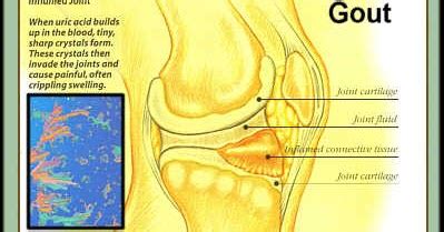 Gout in the Knee: What is Gout in the Knee