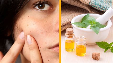 How to Use Tea Tree Oil for Acne - YouTube