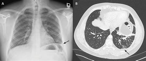 Loculated Pleural Effusion Meaning - Pneumonia And Pleural Effusion ...