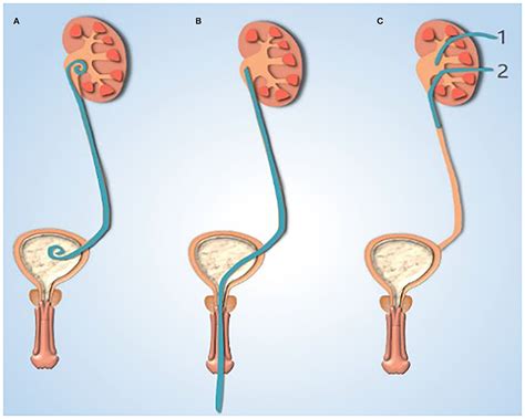 Frontiers | Comparison of Drainage Methods After Pyeloplasty in Children: A 14-Year Study