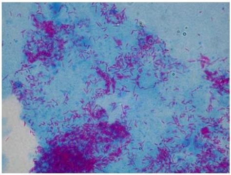 Ziehl-Neelsen acid-fast staining procedure | Medical Laboratories