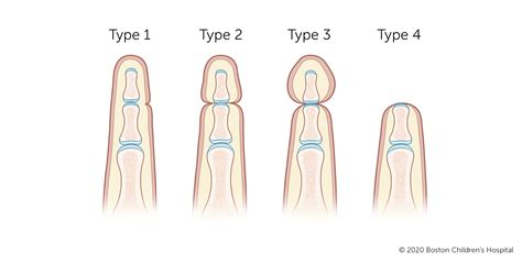 Amniotic Band Syndrome | Boston Children's Hospital