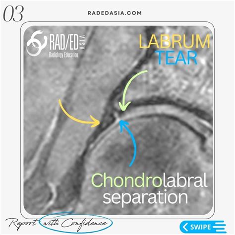 HIP LABRUM LABRAL TEAR MRI RADIOLOGY - Radedasia